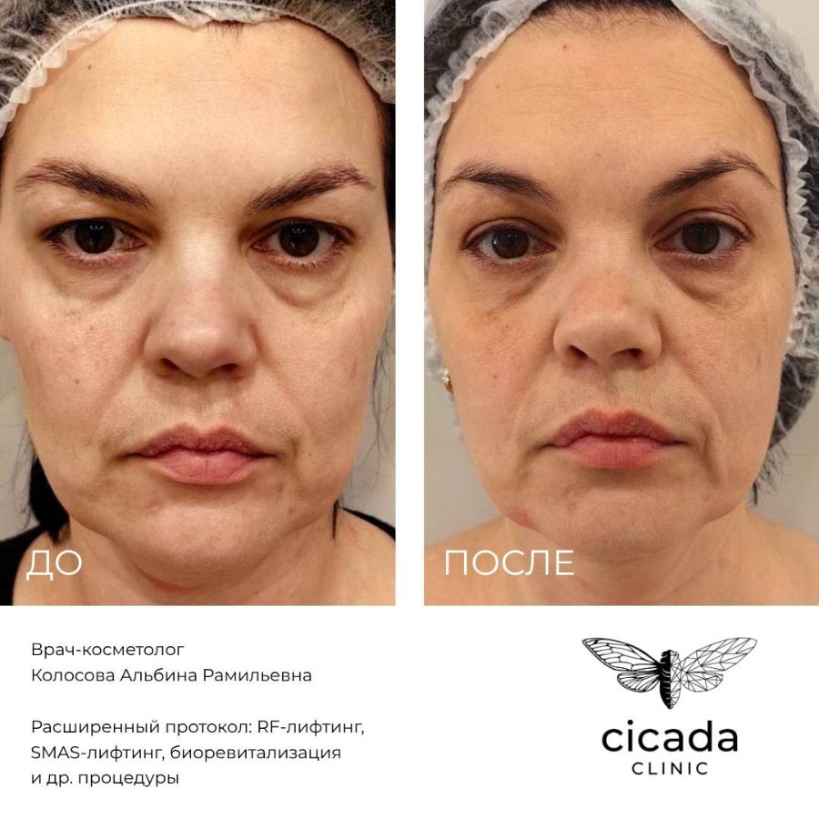Смас-лифтинг Колосова Альбина Рамильевна - Врач-косметолог cicada-clinic