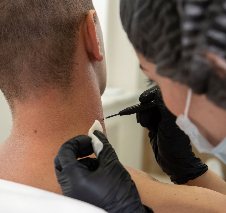 в Cicada Clinic на процедуру удаления новообразований