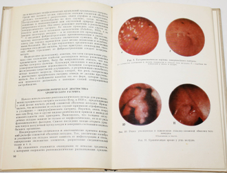 Фишзон - Рысс Ю.И. Гастриты.  Л.: Медицина 1974г.