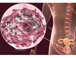 Бак.вагиноз: взгляд гинеколога