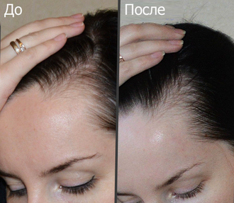 FEG Hair Regrowth Spray - Средство для интенсивного роста и от выпадения волос - 60 мл