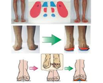 Коррекция отклонений, деформаций стоп и укорочения ноги