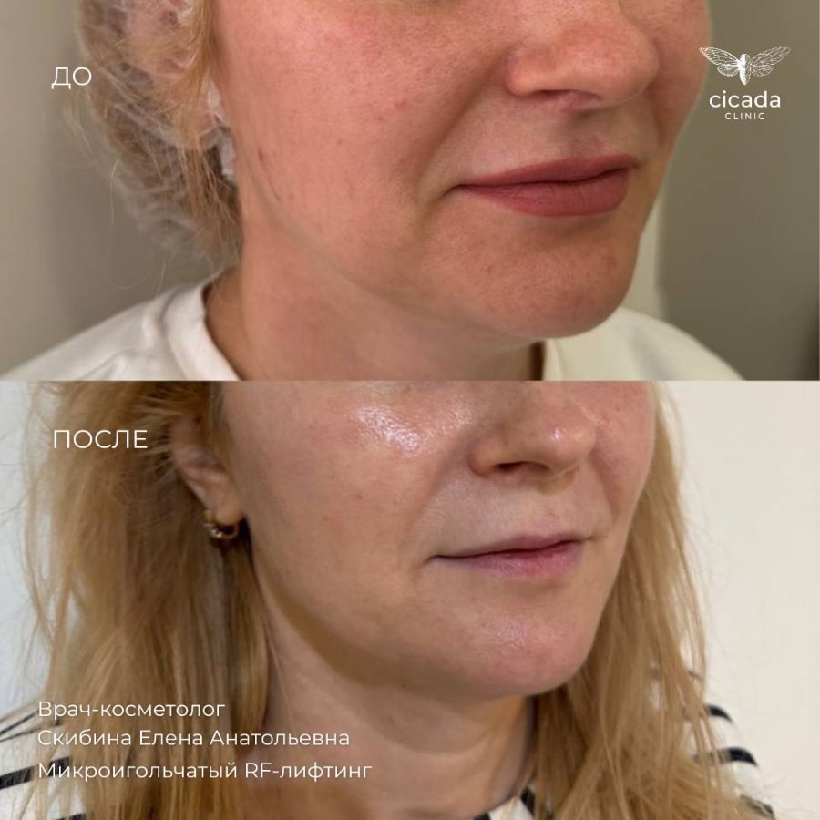 Услуга RF - лифтинг в Твери в Сicada Clinic Микроигольчатый RF-лифтинг