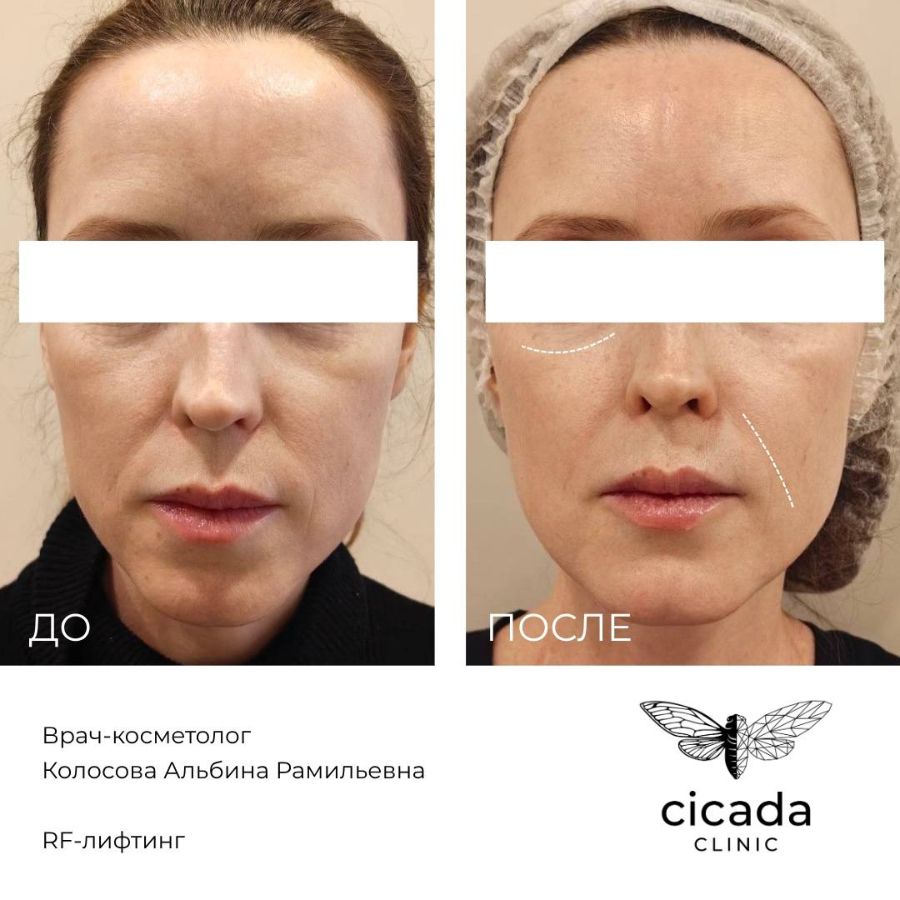Микроигольчатый RF-лифтинг результат Сicada Clinic
