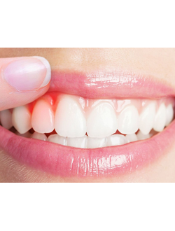 ОТ ВОСПАЛЕНИЯ ДЕСЕН