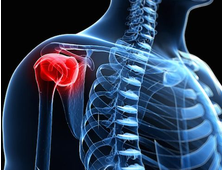Лечение артрита плечевого сустава