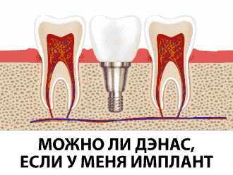 МОЖНО ЛИ ДЭНАС, ЕСЛИ У МЕНЯ ИМПЛАНТ