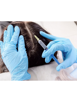 Подкожное введение озонокислородной смеси в область волосистой части головы