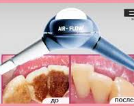 Профессиональная гигиена (Ультразвук+АэрФло) все зубы