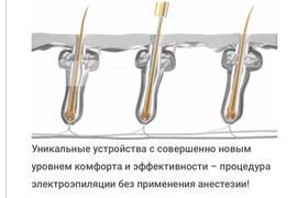 Электроэпиляция
