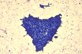 КУРС: "Морфологическая диагностика заболеваний молочной железы"