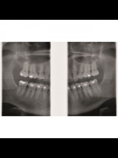 Gendex GXDP-300™ - Цифровая панорамная рентгенодиагностическая система | KAVO DENTAL (Германия)