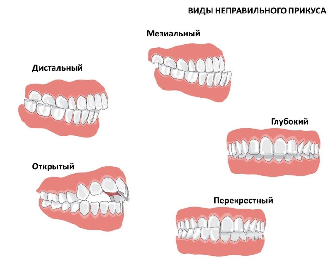 Виды неправльного прикуса