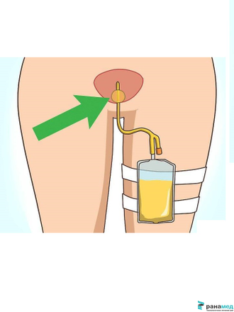 Катетер Фолея двухходовой, латексный Zhanjiang Star, Ch/Fr 30, объем баллона 30 мл (Китай)