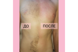 Депиляция спины/груди для мужчин