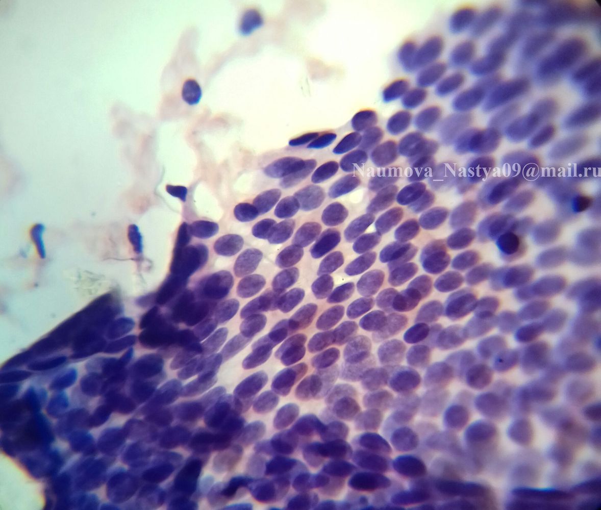 жел. ретикулосаркома гистология. цитология фиброаденомы. цитология фиброаденомы. методы окраски цитологических препаратов.