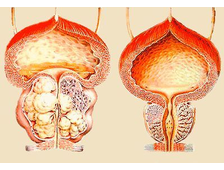 Лечение аденомы простаты