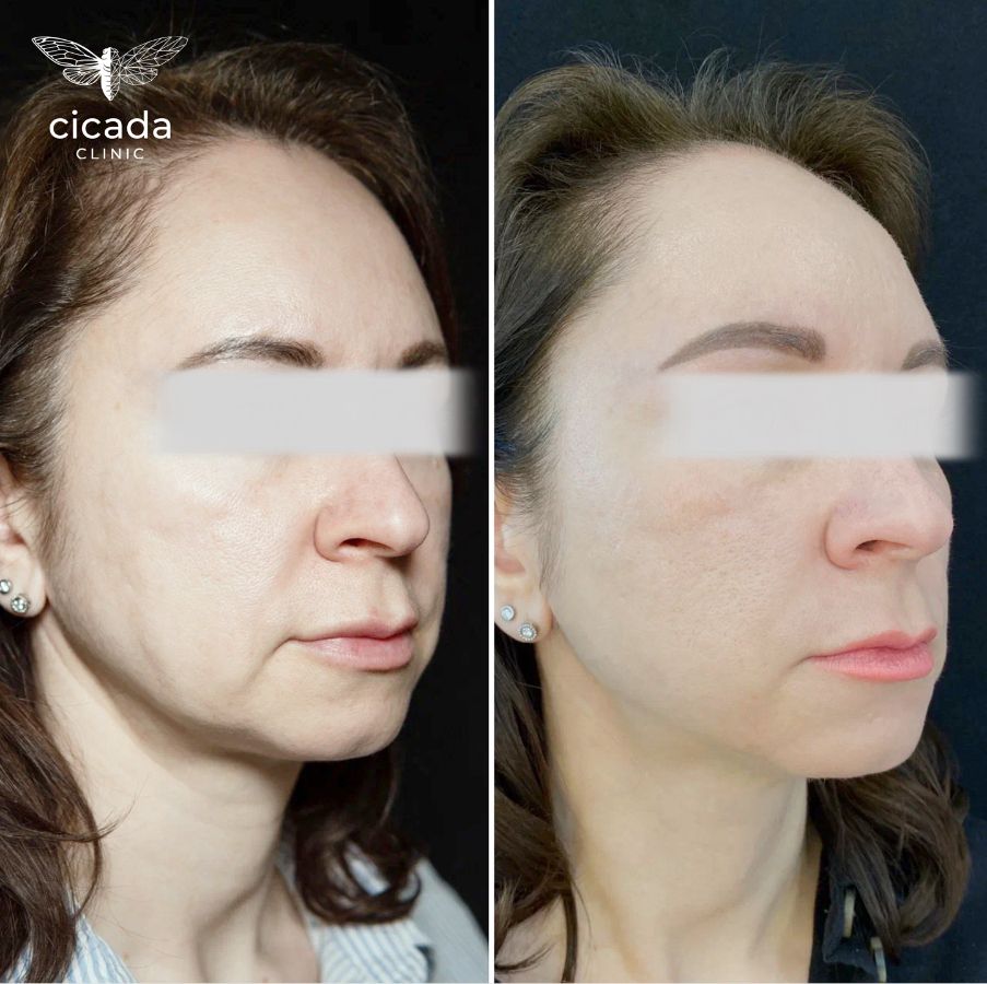 Нитевой лифтинг APTOS Cicada Clinic
