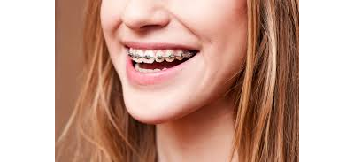 Воск ортодонтический в полосках, PresiDENT, 7 шт. (модификация 1)