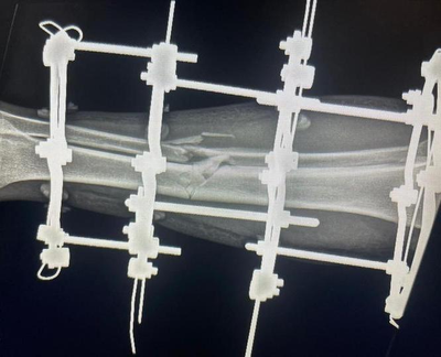 аппарат илизарова, стержень, спицы, удлинение конечностей, ЦИТО, РНЦ ВТО, илизаров, аппарат
