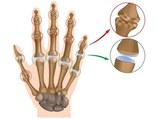 Лечение суставов рук