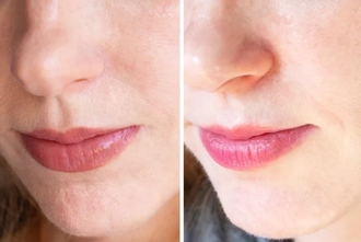 A313 чистый ретинол (50g) Vitamine A Pommade - Met Retinol. Крем против морщин, от прыщей и черных точек