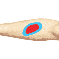 Зона отека, укуса. ДЭНАС ПКМ [НЕЙРОДЭНС] 