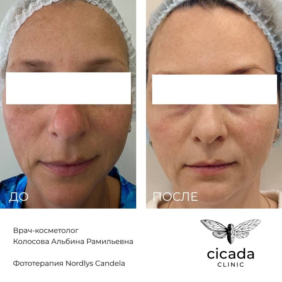 Фототерапия Колосова Альбина Рамильевна - Врач-косметолог cicada-clinic