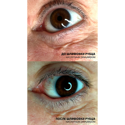 Ремувер с гликолевой кислотой 11% (GLYCOLIC ACID REMOVER) AS Company, 6 мл