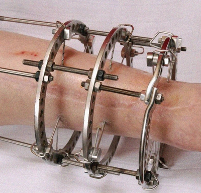 аппарат илизарова, стержень, спицы, удлинение конечностей, ЦИТО, РНЦ ВТО, илизаров, аппарат