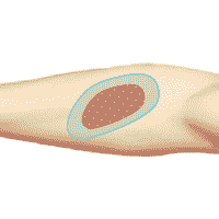 Зона пораженного участка кожи. ДЭНАС ПКМ [НЕЙРОДЭНС] 