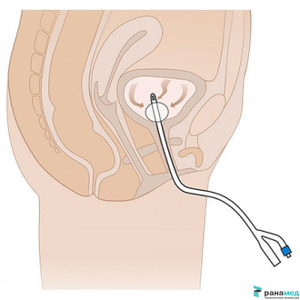 Катетер Фолея силиконовый двухходовой MEDEREN, Ch/Fr 16, объем баллона 30 мл (Израиль)