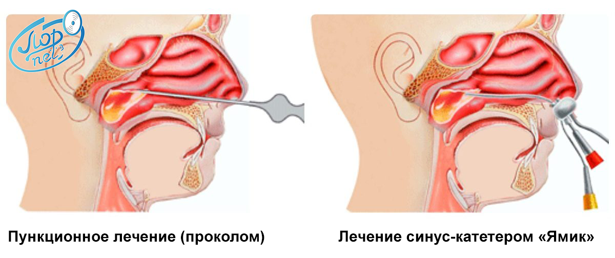 lechenie-gaymorita-sinus-kateterom-yamik-v-krasnoyarske