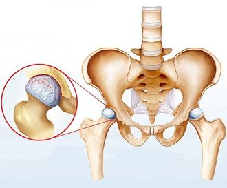 Лечение артрита тазобедренного сустава
