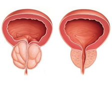 Лечение простатита