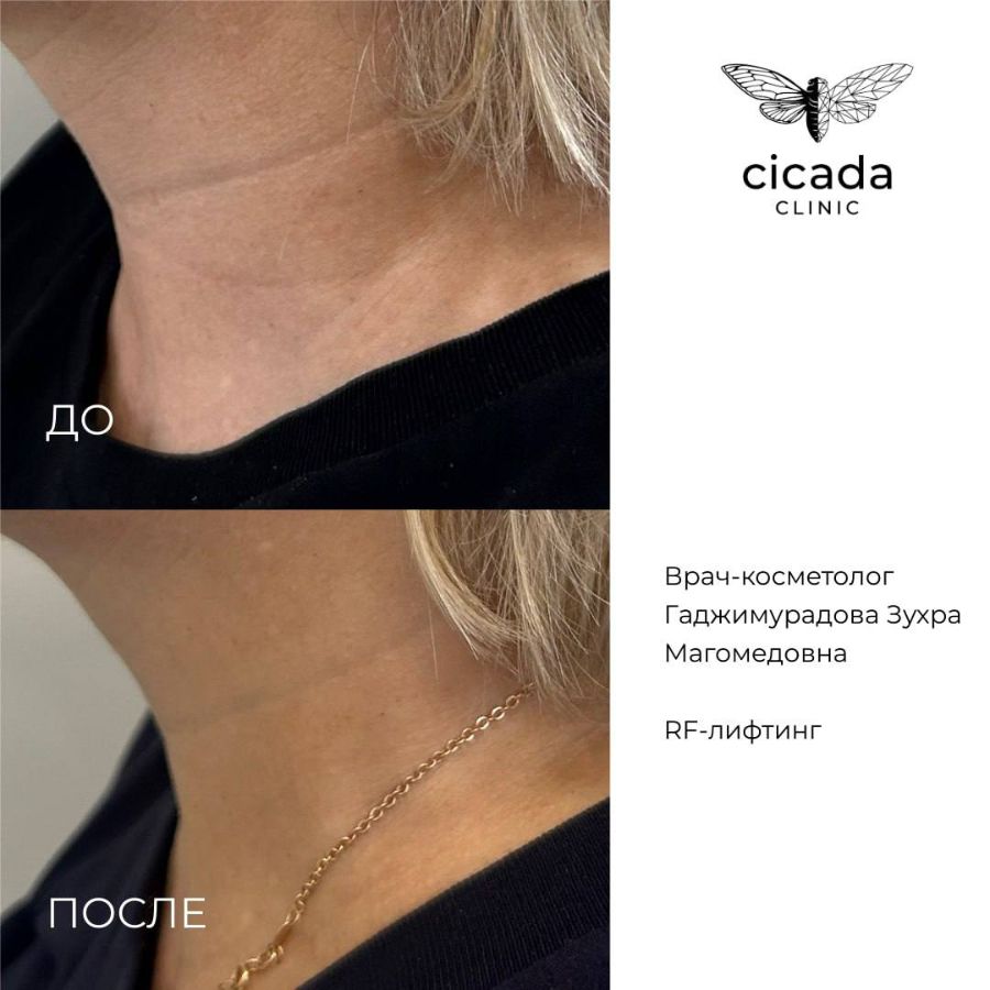 Гаджимурадова Зухра Магомедовна   Врач-Косметолог,  Дерматовенеролог - cicada