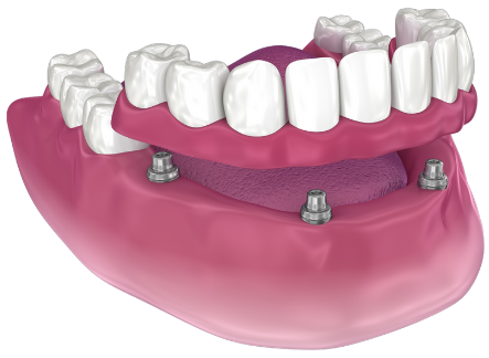 Имплантация все на четырех Новосибирск Адентал