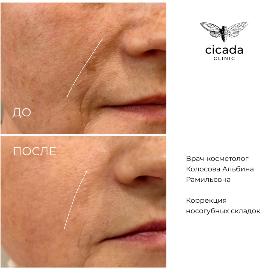 Результат процедуры - Контурная пластика лица в Cicada Clinic Цикада Клиник Тверь