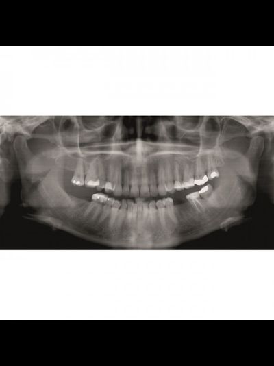 Gendex GXDP-300™ - Цифровая панорамная рентгенодиагностическая система | KAVO DENTAL (Германия)