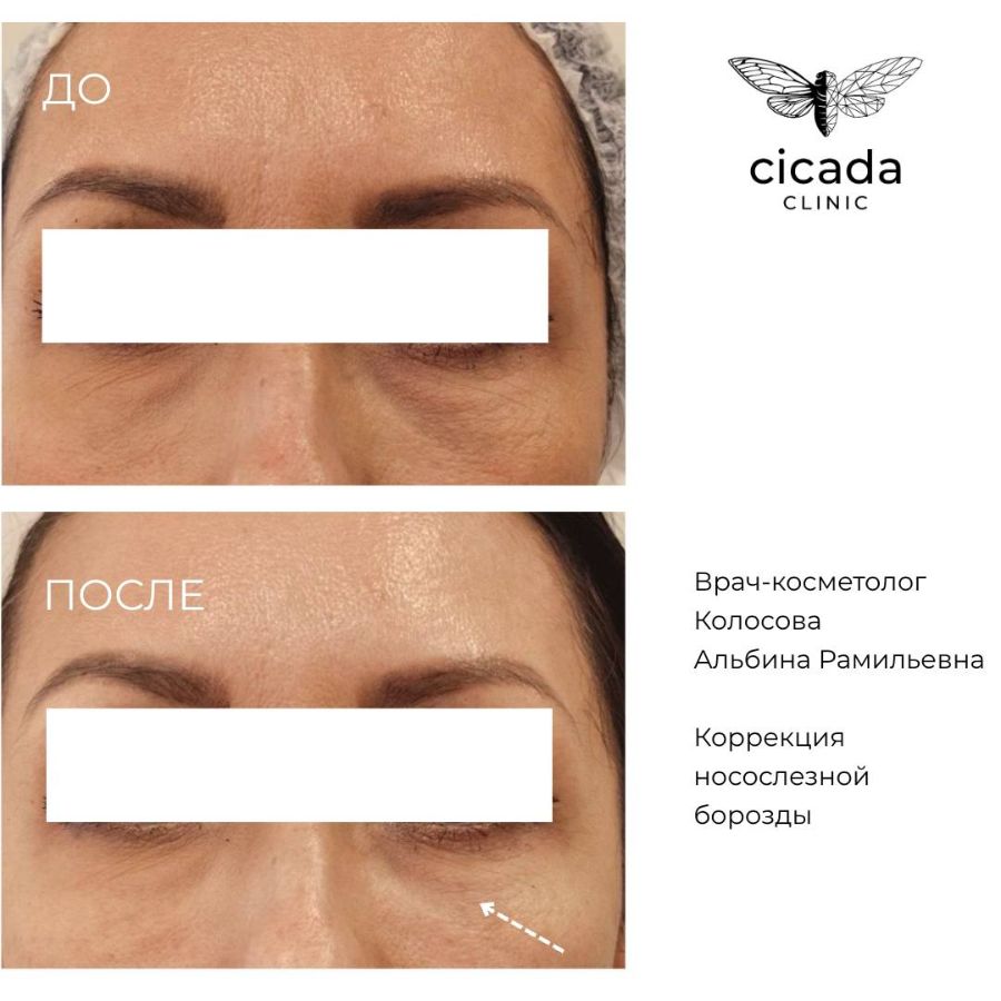 Результат Колосова Альбина Рамильевна - Врач-косметолог cicada-clinic