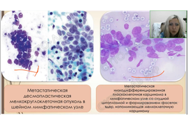 Цитологическая диагностика метастазов (онлайн курс)