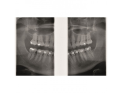 Gendex GXDP-300™ - Цифровая панорамная рентгенодиагностическая система | KAVO DENTAL (Германия)