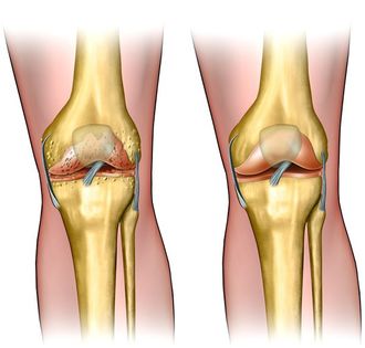 Лечение остеоартроза коленного сустава
