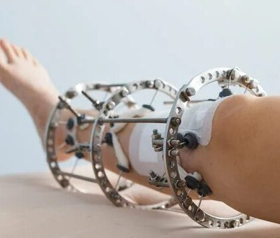 аппарат илизарова, чрескостный остеосинтез, удлинение конечностей, ЦИТО, РНЦ ВТО, кронштейн