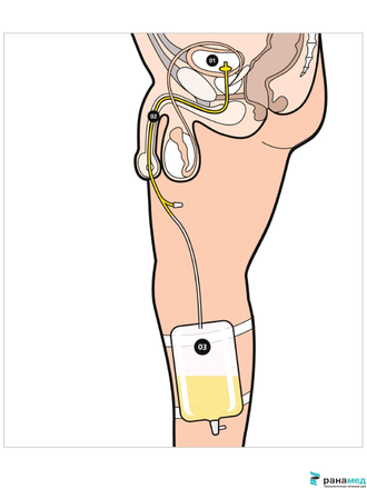 Катетер Фолея двухходовой, латексный Zhanjiang Star, Ch/Fr 16, объем баллона 30 мл (Китай)