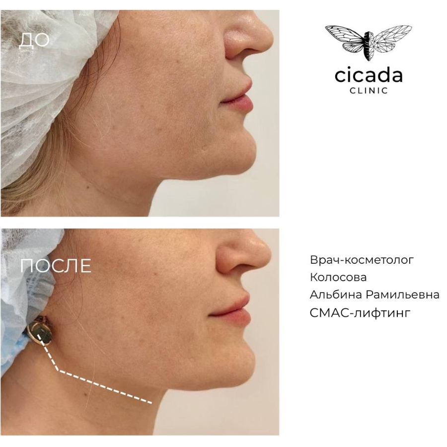 смас лифтинг результат в Cicada Clinic