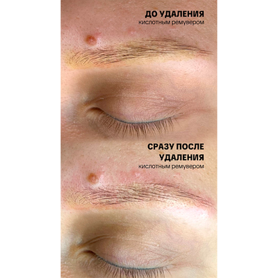 Ремувер с гликолевой кислотой 11% (GLYCOLIC ACID REMOVER) AS Company, 6 мл