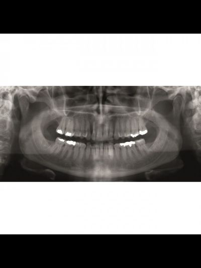 Gendex GXDP-300™ - Цифровая панорамная рентгенодиагностическая система | KAVO DENTAL (Германия)