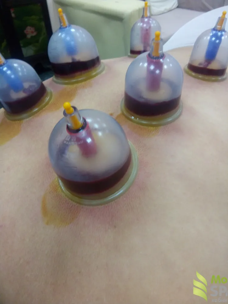 Лечебное кровопускание ( Хиджама)