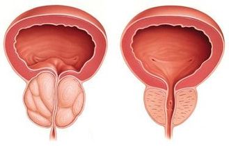 Лечение простатита